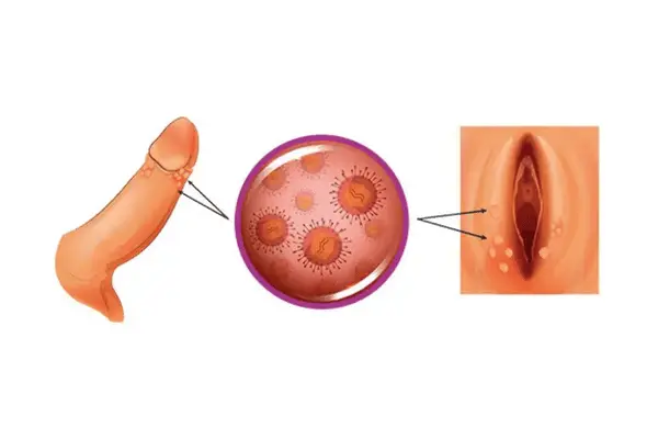 Genital Siğil Neden Olur?