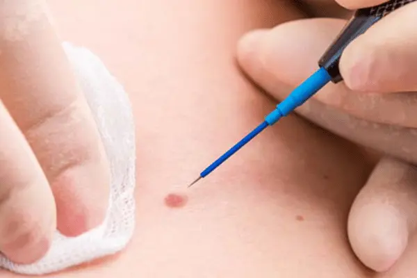 Genital Siğilden Korunma Yolları