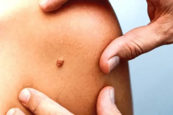 Genital Siğil Nasıl Geçer? Tedavi Yöntemleri