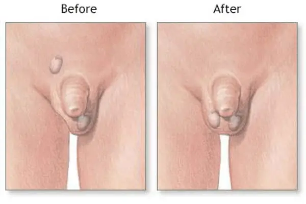 İnmemiş Testis Tedavisi: Orşiopeksi (Cerrahi Düzeltme) Detayları